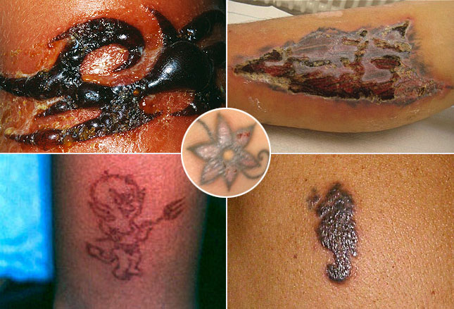 skin reactions to tattoo ink ingredients