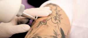 what-is-laser-therapy-tattoo-removal