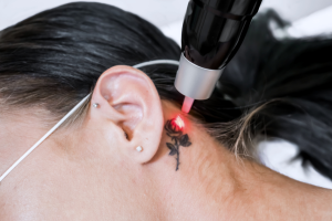 tattoo-removal-cold-laser