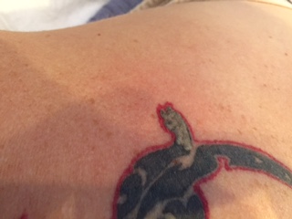 renude_laser_tattoo_removal_frosting