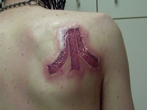 tattoo that has had laser treatment to remove it and resulted in severe burning and scarring