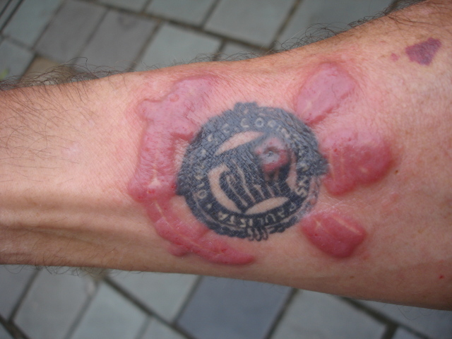 Tattoo Removal Gone Wrong: How To Avoid A Tattoo Removal Disaster!