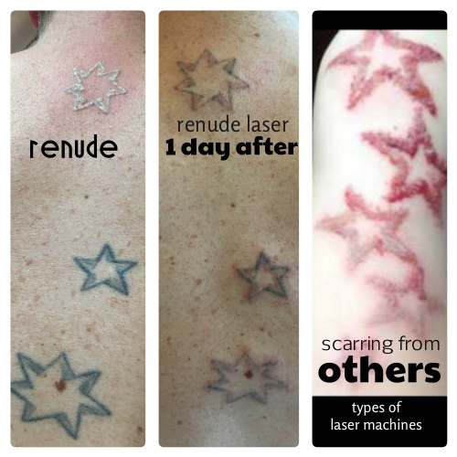 Laser Tattoo Removal Aftercare  Process Instructions