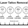 Does laser tattoo removal hurt?