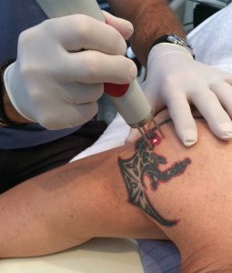tattoo removal pain