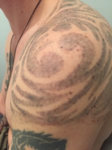 The Laser Tattoo Removal Healing Process | Removery