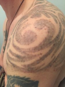 How to Care for Skin After Tattoo Removal  Black Amethyst Tattoo Gallery