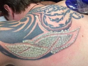 Why does tattoo removal itch and what can you do about it