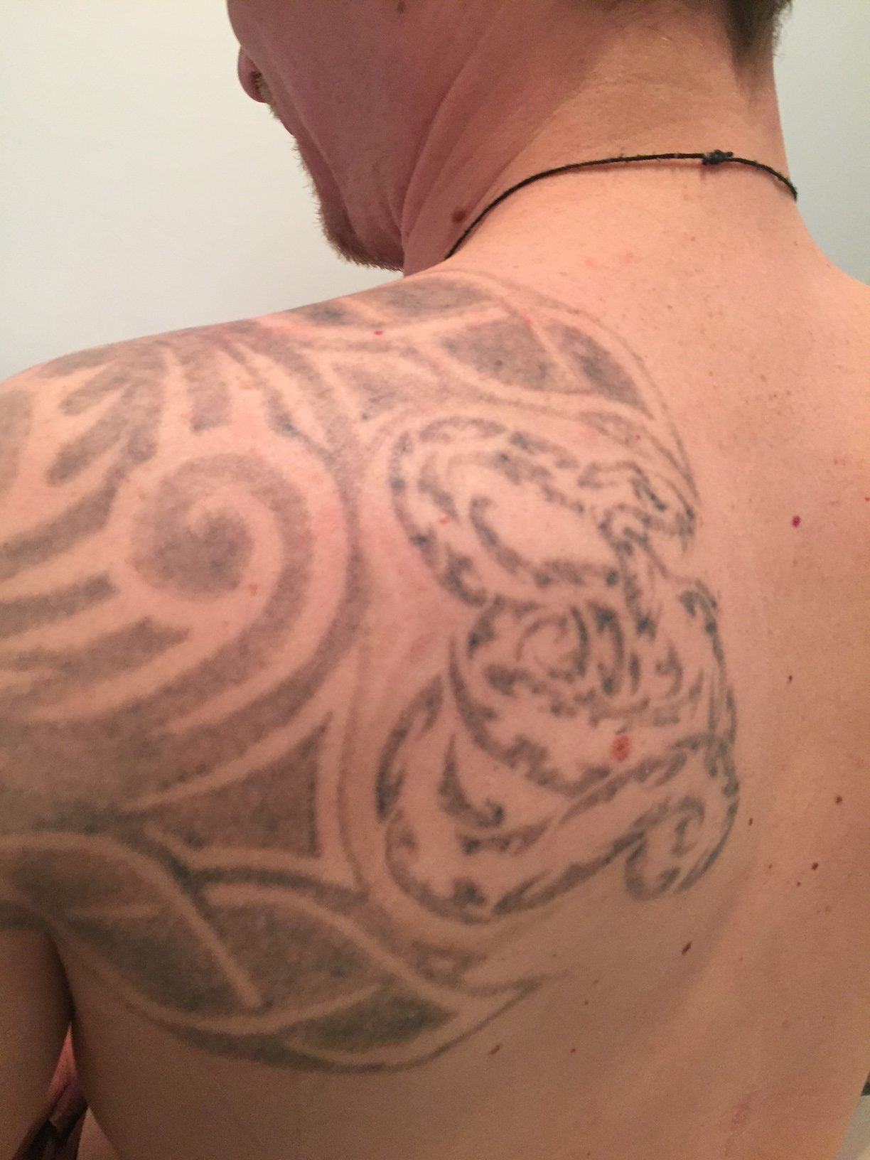 My tattoo removal experience  Beauty and the blonde