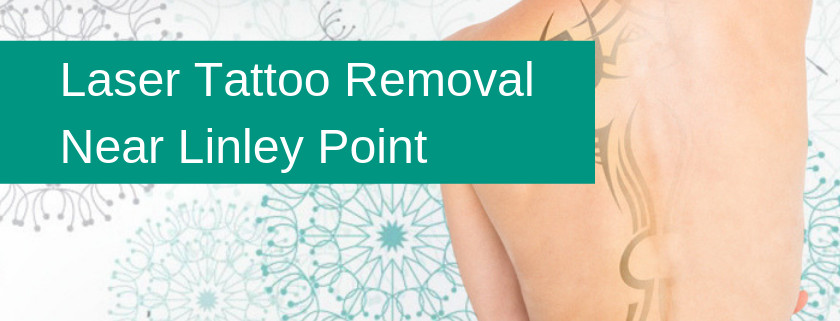 Laser Tattoo Removal Linley Point Banner