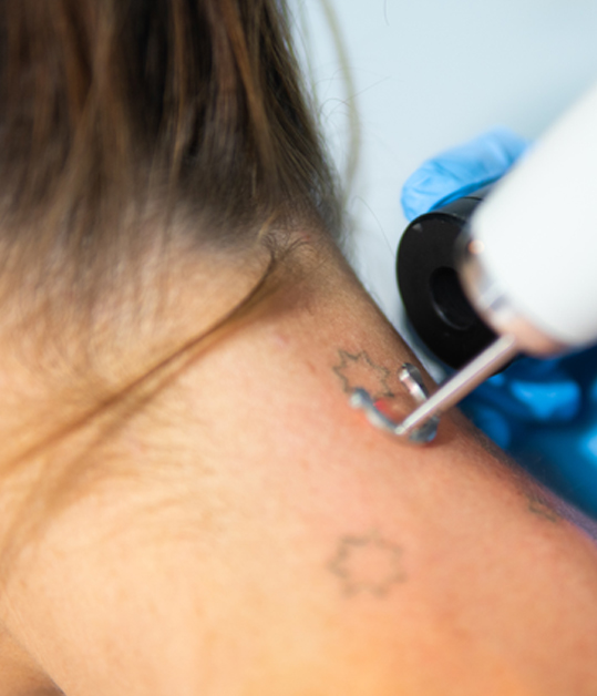 Laser Tattoo Removal in Sydney CBD, Inner and Outer Sydney
