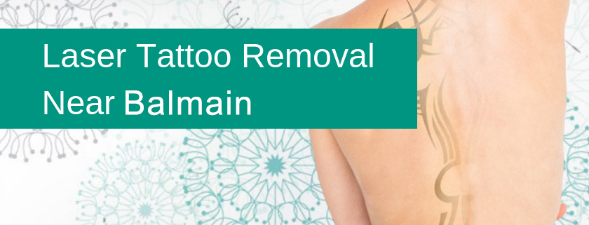laser tattoo removal balmain