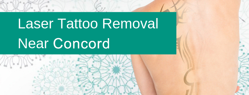 laser tattoo removal concord
